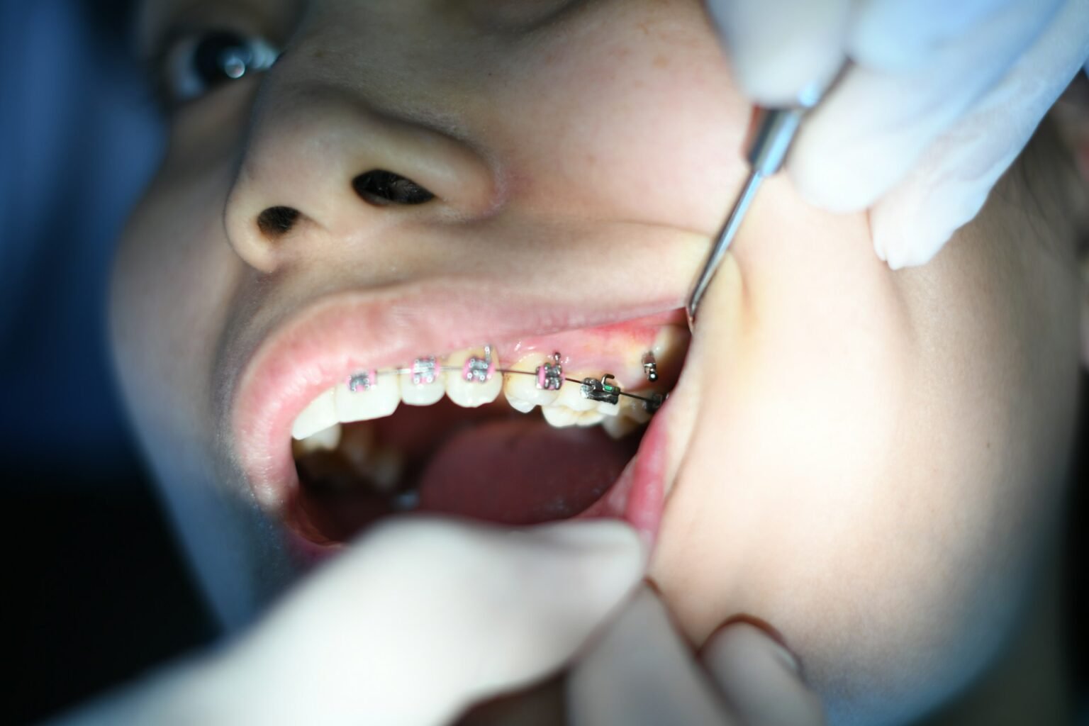 How Much Do Retainers Cost to Replace on the NHS? A Complete 2026 Guide
