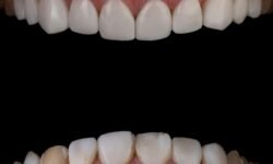 Partial Dentures Before and After Transforming Smiles and Restoring Confidence