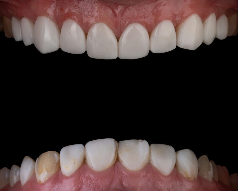 Partial Dentures Before and After Transforming Smiles and Restoring Confidence