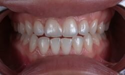 What Is a Scale and Polish A Complete Guide to Brighter, Healthier Teeth