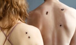 Mole Checker How AI Is Transforming Skin Check and Early Detection